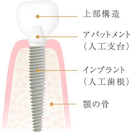 インプラントの仕組み