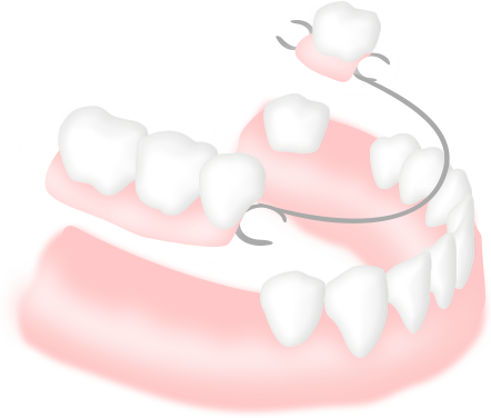 部分入れ歯の仕組み